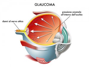 Glaucoma