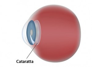 Cataratta