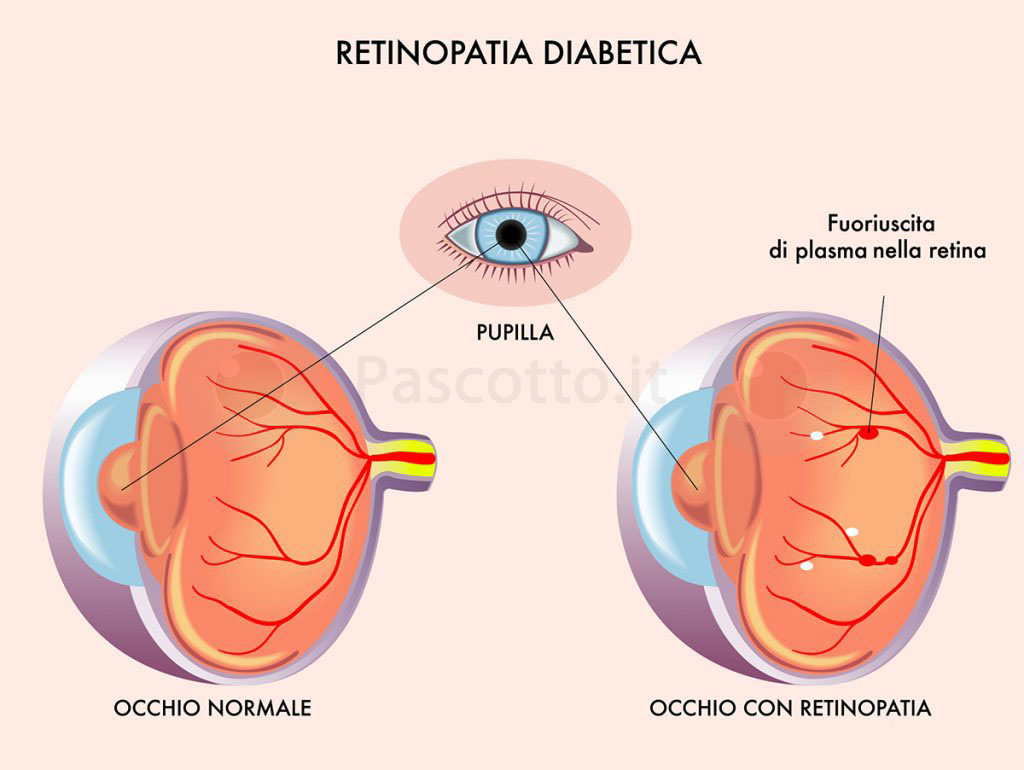 Retinopatia Diabetica